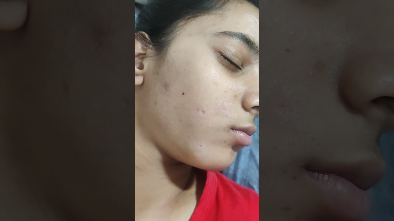 Best Scar Laser Treatment in ZIRAKPUR- Call now at 98769-31601