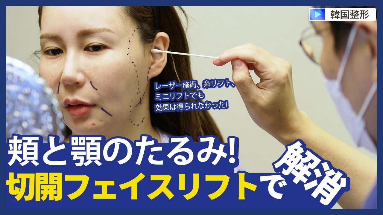 [韓国JAYJUN整形外科]今度こそちゃんとリフトさせたい!✨ 切開フェイスリフトでたるみを解決して童顔に!!😊