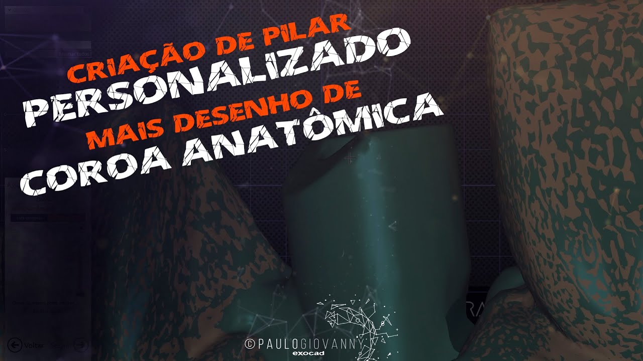 Pilar personalizado mais coroa anatômica.