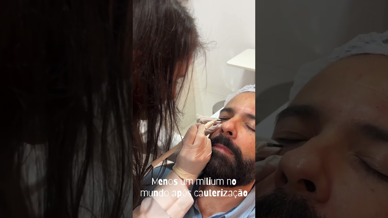 Eliminando miliums com cauteriza&ccedil;&atilde;o #mealthclinic #dermatologista #dermatologia