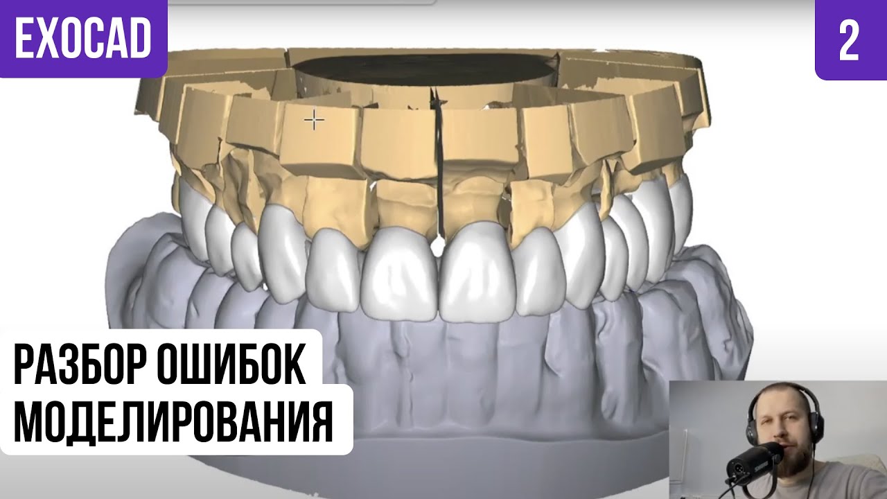 Exocad разбор ошибок моделирования реальный клинический случай часть 2