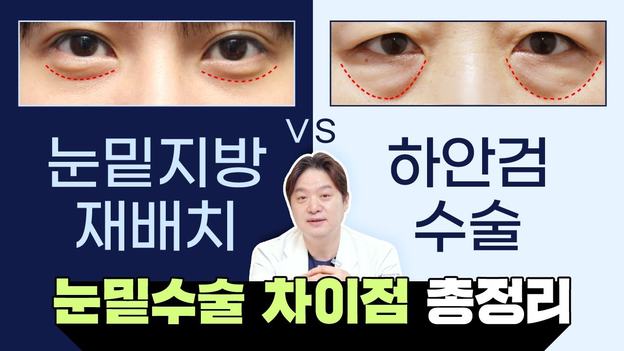 불룩한 눈밑지방, 재배치 해야할까 하안검 해야할까? 눈밑성형 A to Z