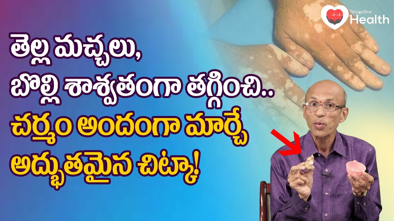 Bolli, Vitiligo | తెల్ల మచ్చలు బొల్లి శాశ్వతంగా తగ్గించే! Dr. Ch Madhusudana Sarma | TeluguOneHealth