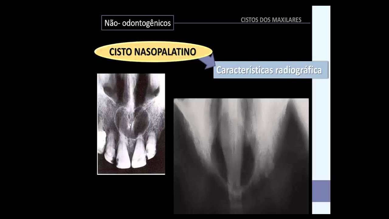 cistos dos maxilares parte 3