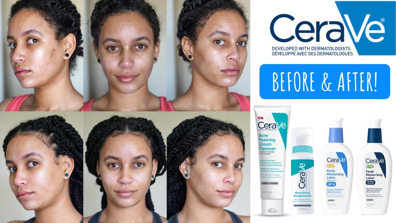 I Tried CeraVe's NEW Acne Skin Care Routine & This Happened!