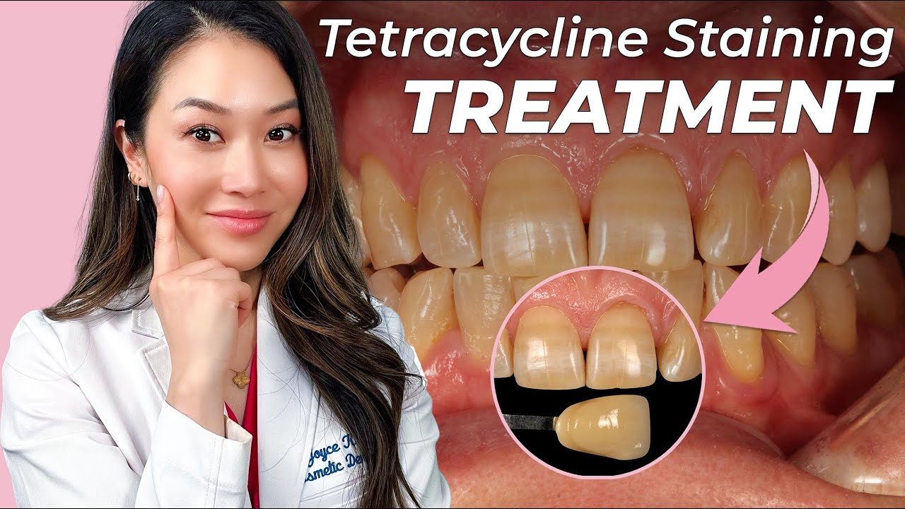 What are Tetracycline Stains?