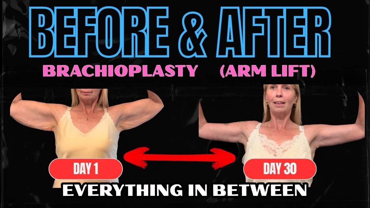 Brachioplasty (Arm Lift) After Weight Loss Day 1 - 30 | The Pain, The Scars, The Results