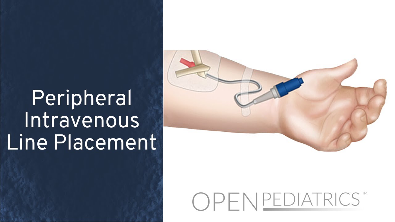 Peripheral Intravenous Line Placement by B. Johnson, L. DelSignore | OPENPediatrics