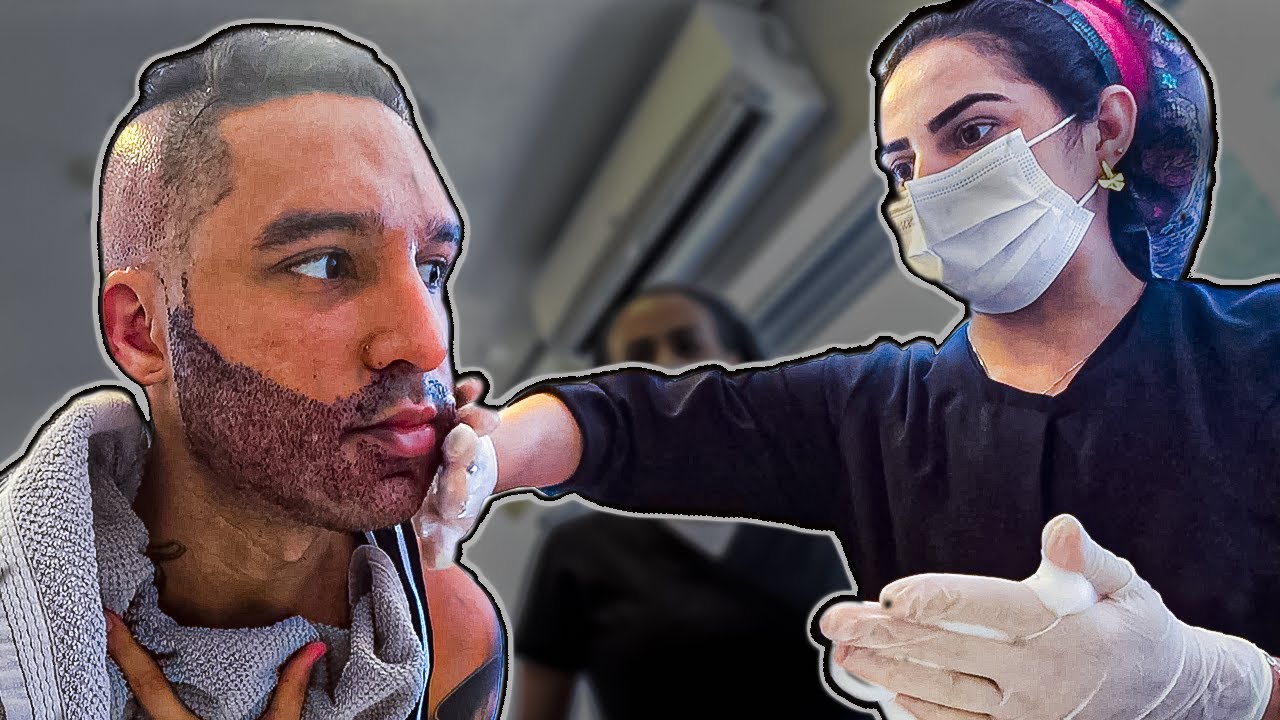 FUI SEDADO MAIS UMA VEZ PRA RETOCAR O TRANSPLANTE DE BARBA
