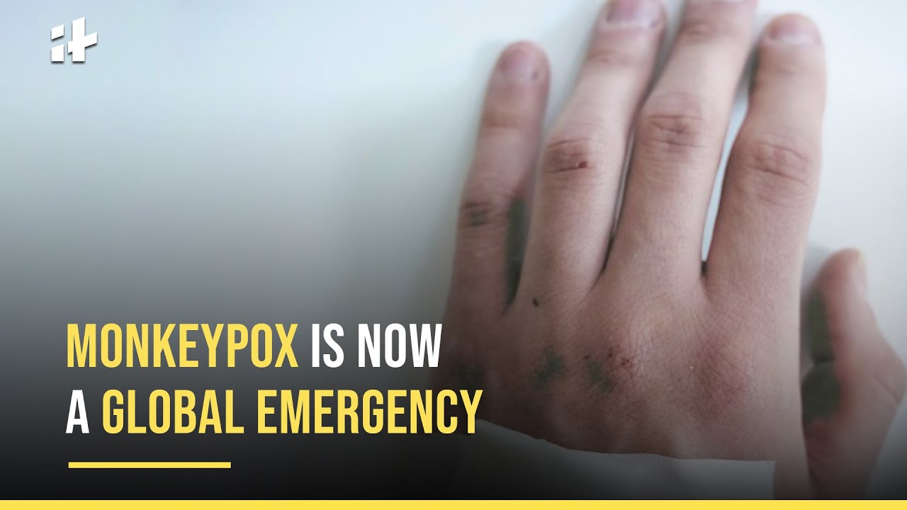 Monkeypox is Now A Global Emergency