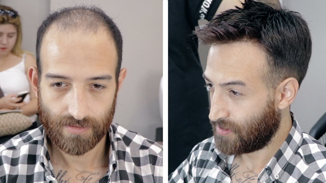 PROTEZ SAÇ UYGULAMASI - Hair Replacement