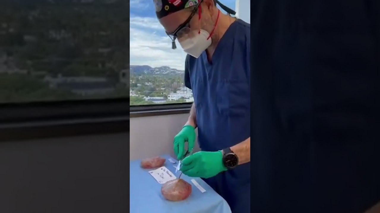 Explant after Capsular Contracture