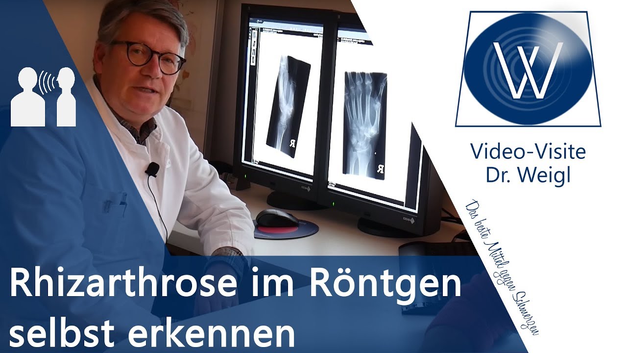 Fingerarthrose & Daumenarthrose im Röntgen selber erkennen🤓 Diagnostik & Radiologie Rhizarthrose