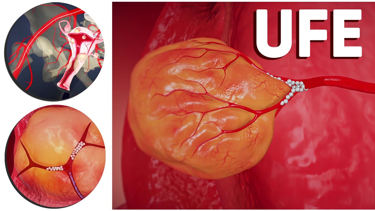 UFE surgery medical animation sample use only