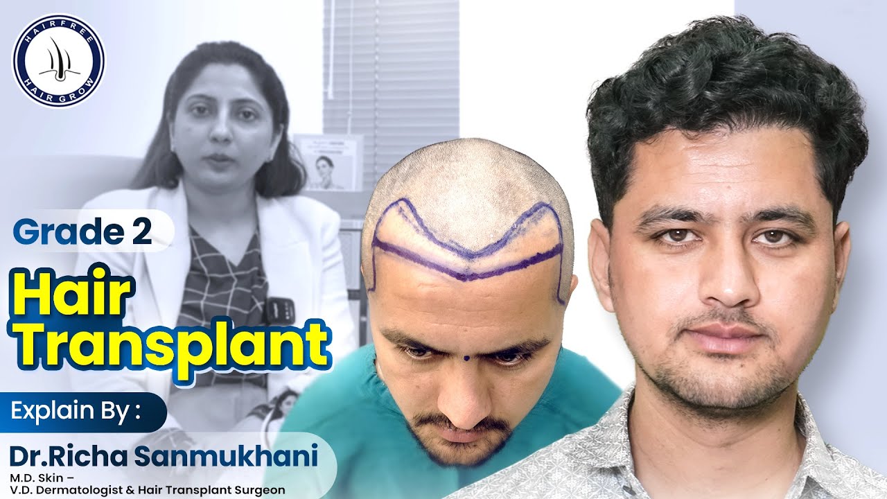 Case Study: 7-Month Hair Transformation by Dr. Richa Sanmukhani | Stunning Results! #hairtransplant
