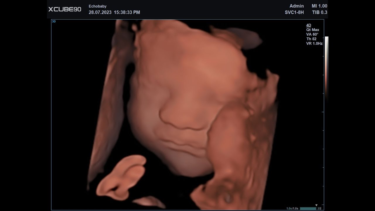 Echo Baby 31 Weken Zwanger 3D Foto's