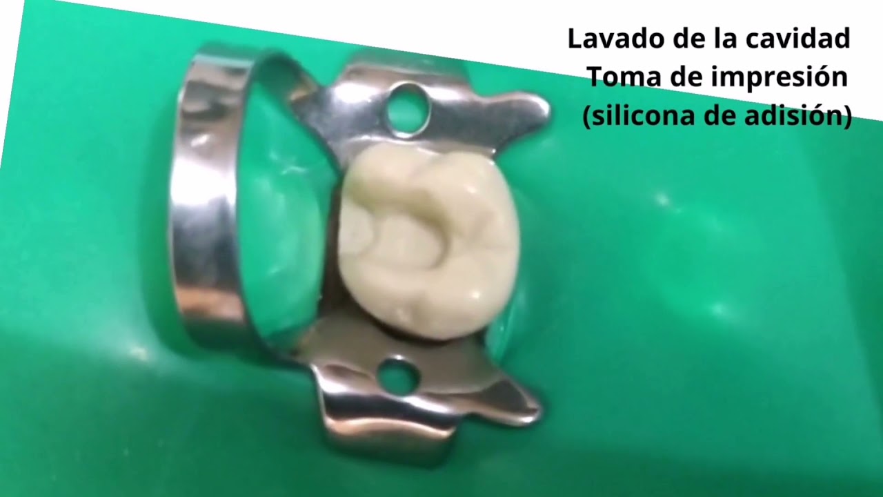 INCRUSTACION INLAY