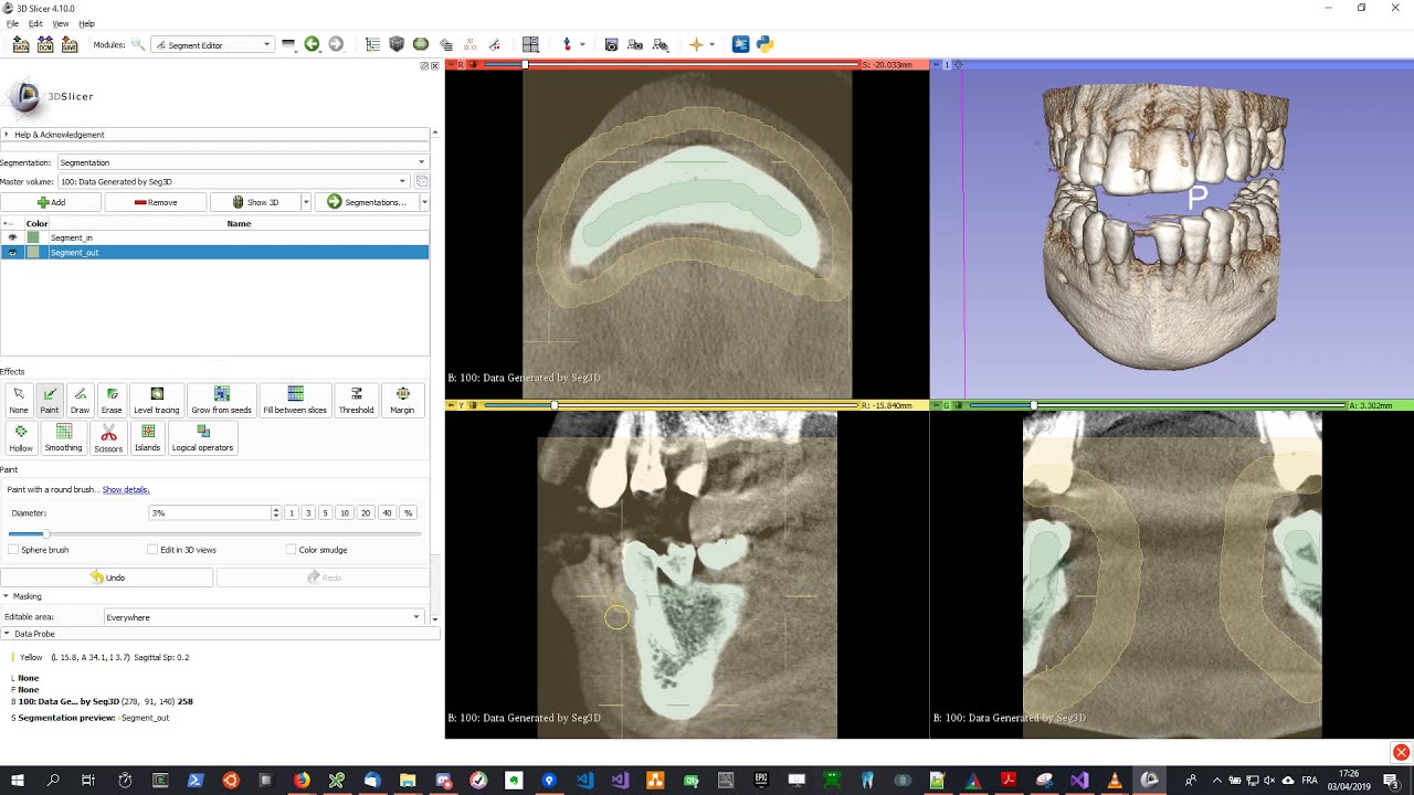 Tutorial: How To Create STL segmentation from DICOM using 3D Slicer (Virteasy Dental / Editor)
