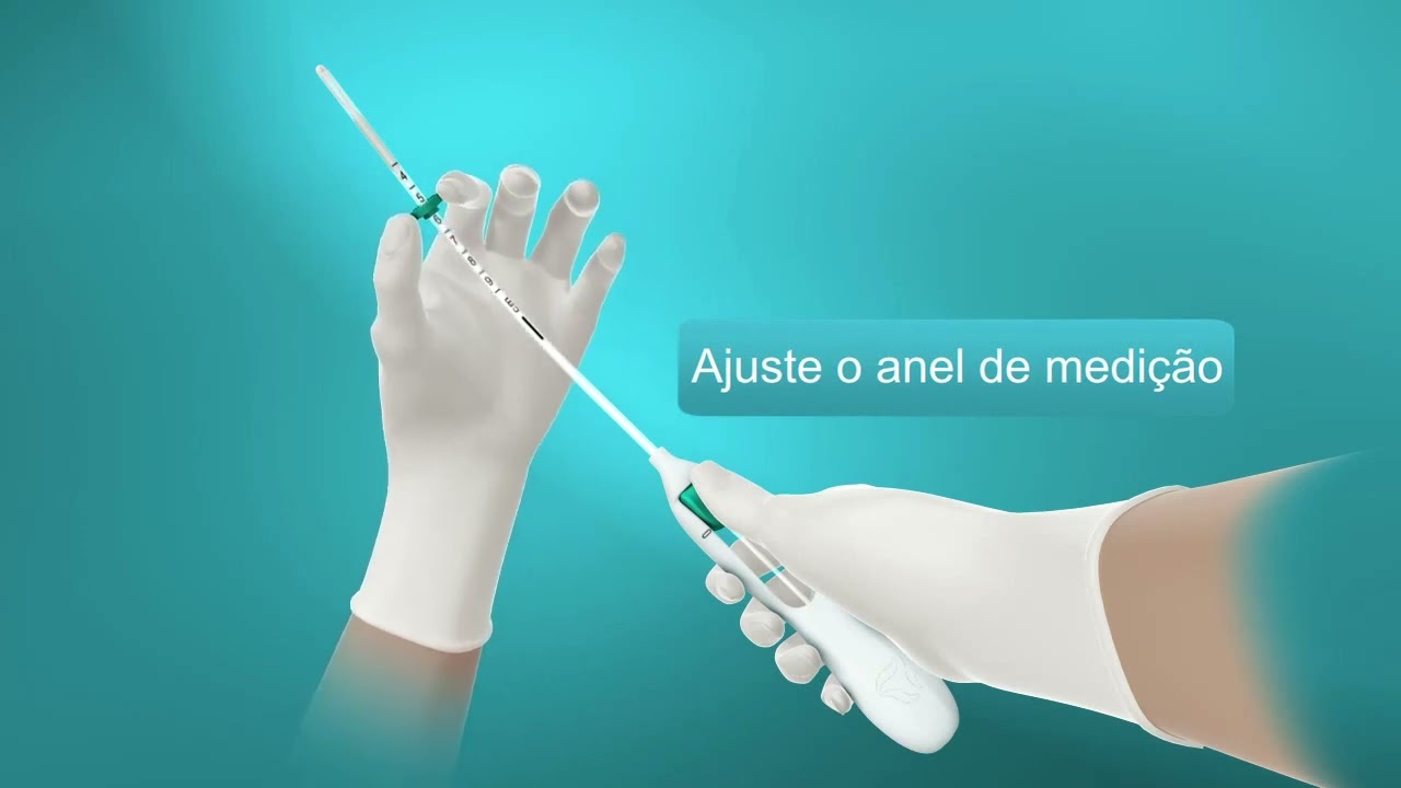 Inserção do DIU hormonal Mirena.