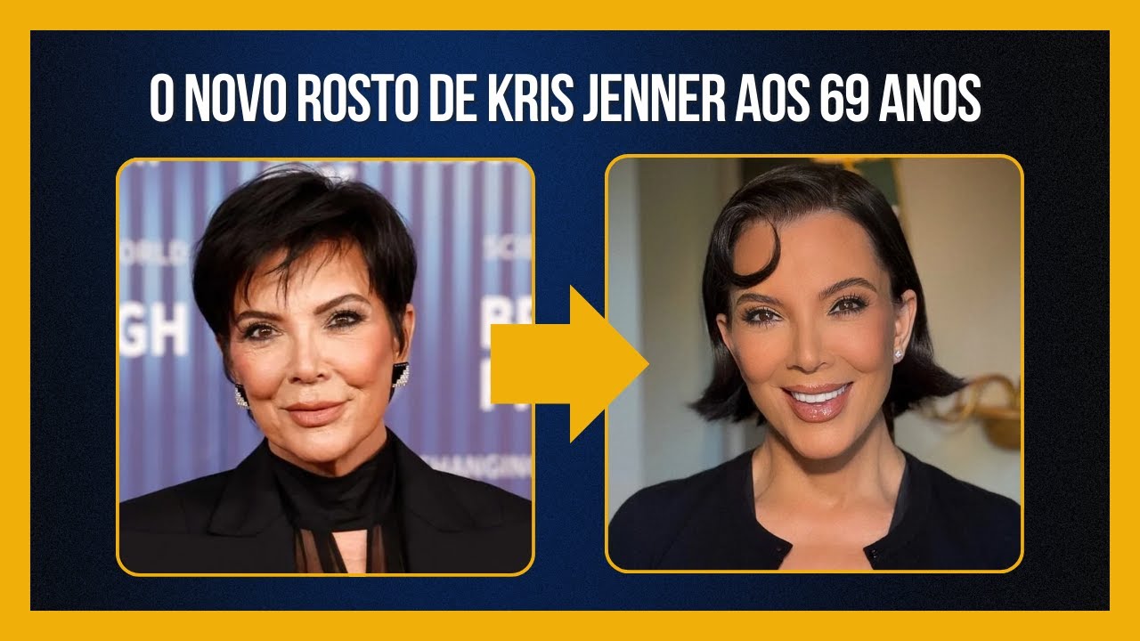 O novo rosto de Kris Jenner aos 69 anos | DEEP PLANE | Dr. Rômulo Viegas | Cirurgião Plástico