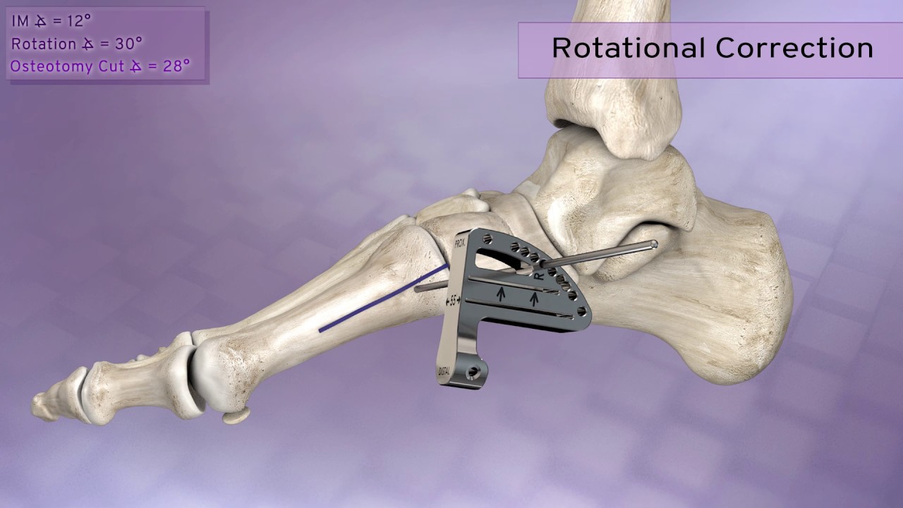 PROMO Triplanar Hallux Valgus Correction System Animation