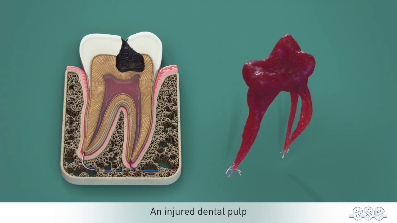 Endodontic treatments
