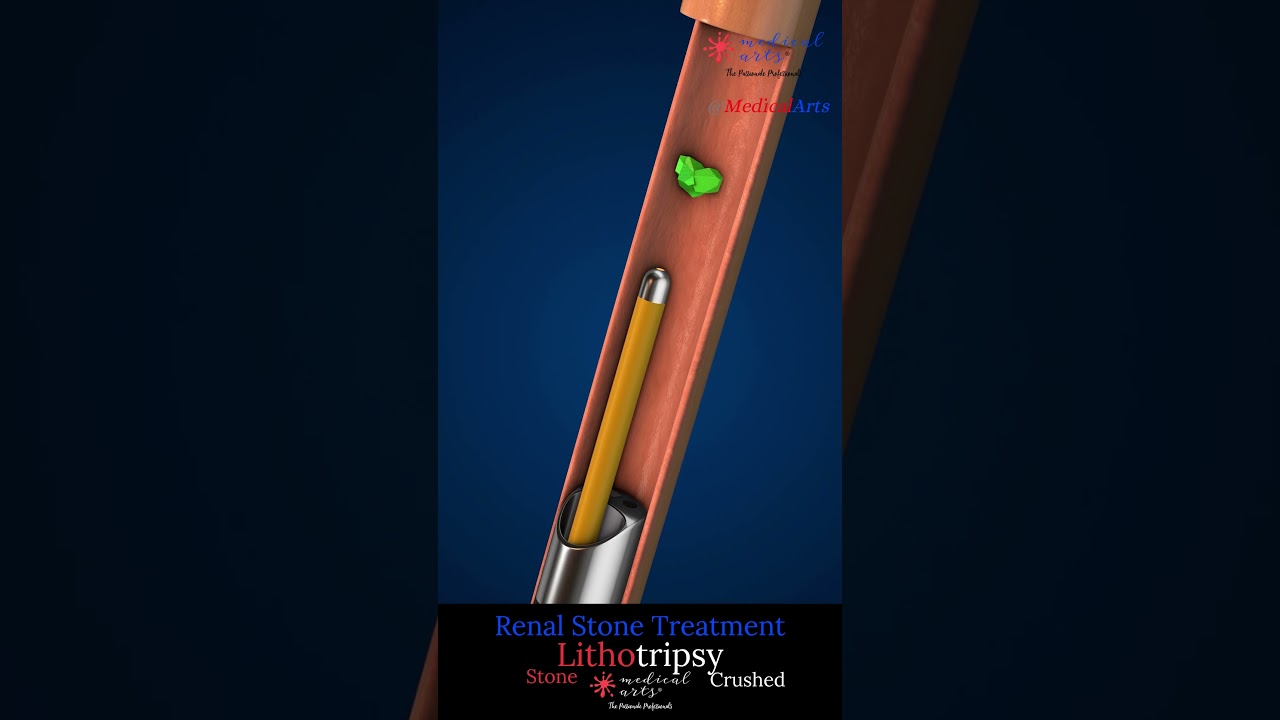How Doctors Remove Kidney Stones Without Surgery! (Lithotripsy demonstrated)