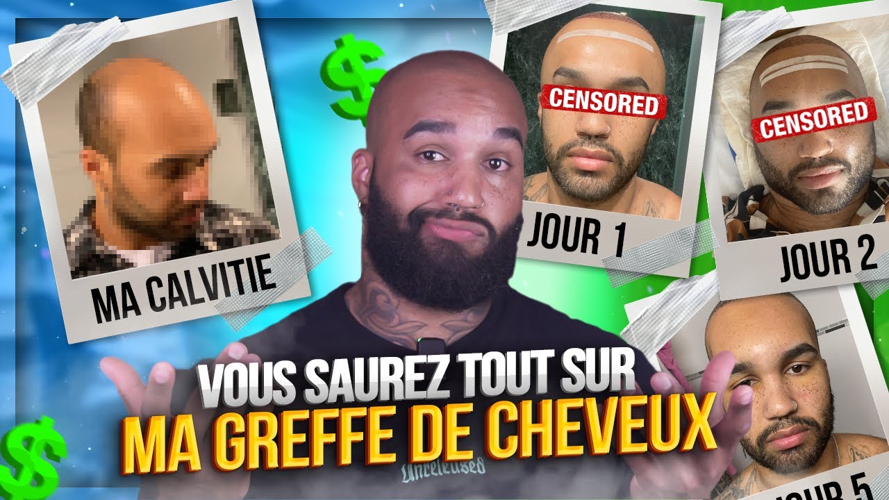 ce que PERSONNE ne vous dira sur LA GREFFE DE CHEVEUX ! ( vidéo non sponso )