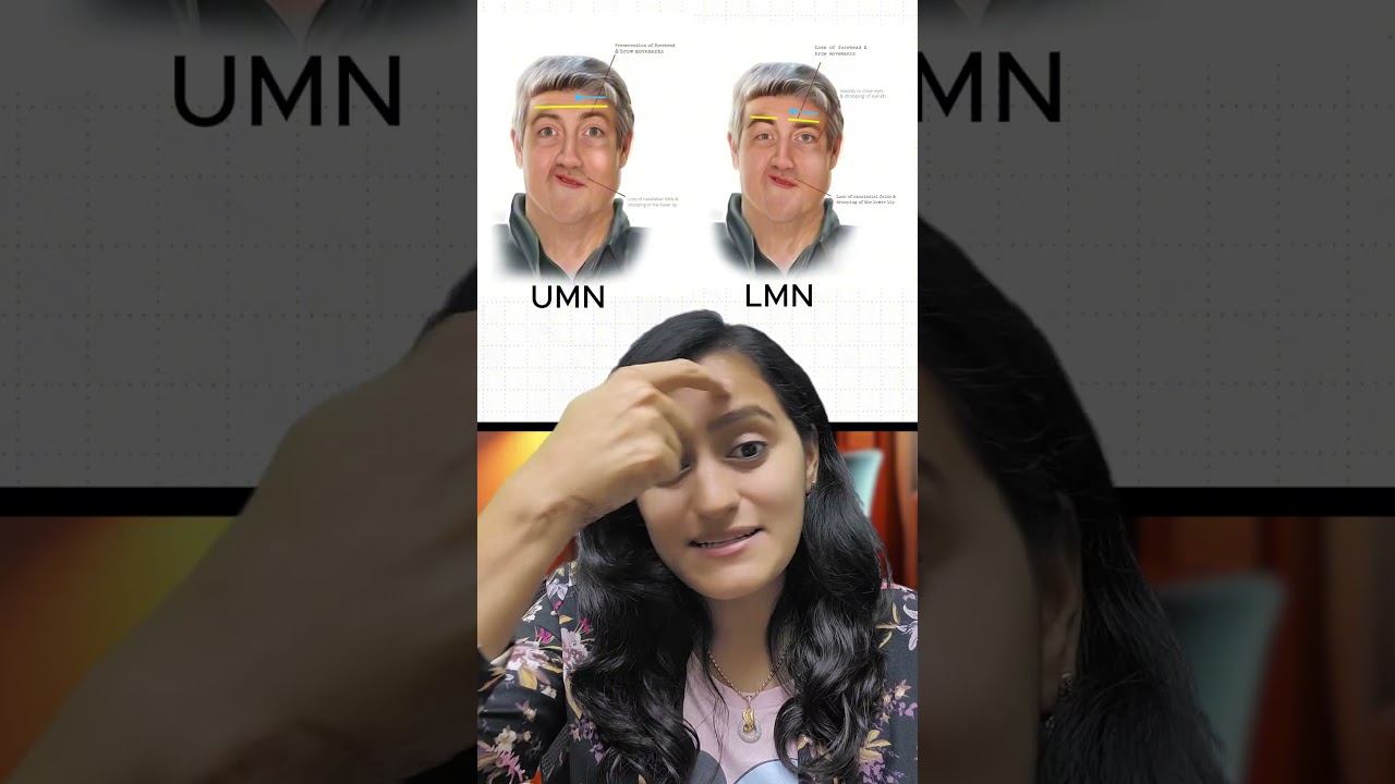 Easiest way to remember Facial Nerve Palsy