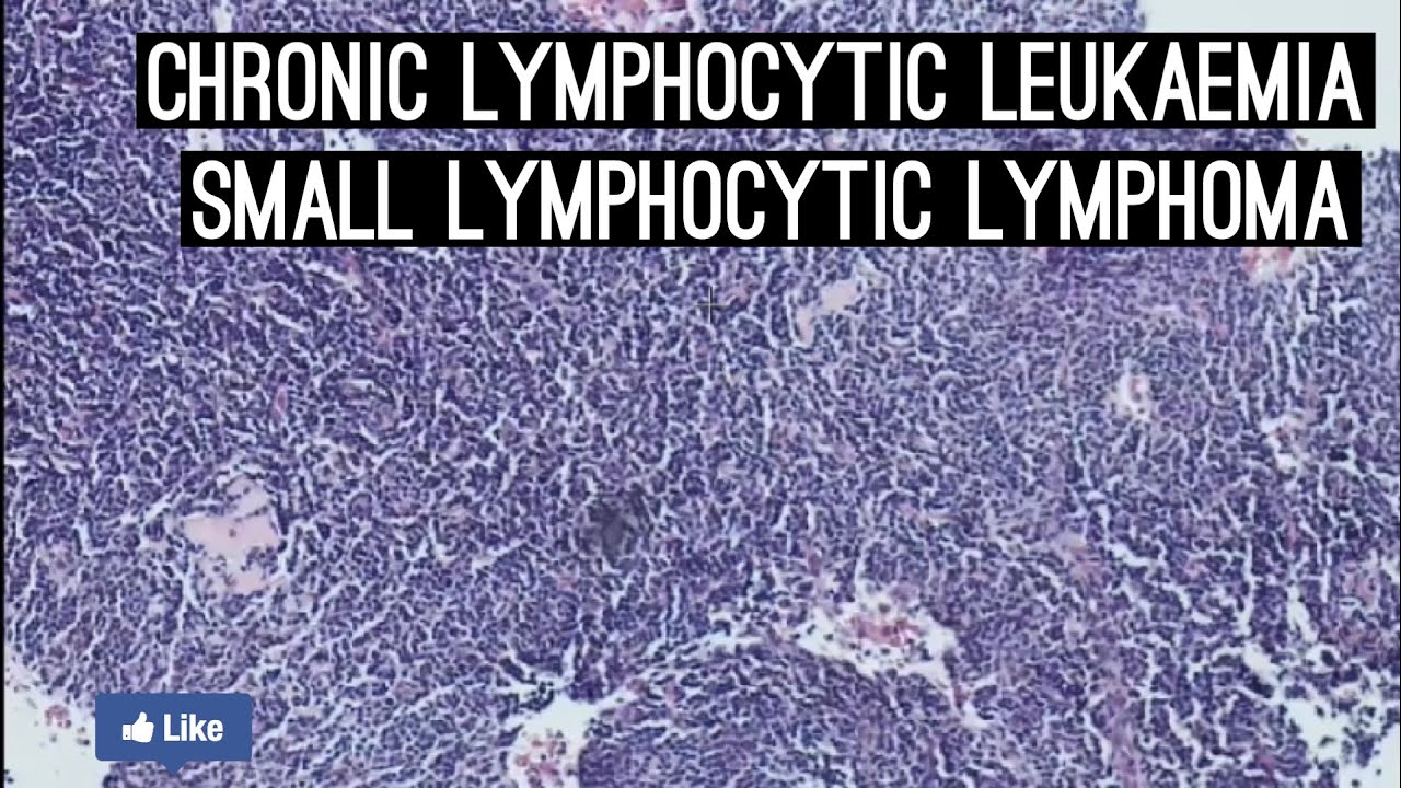 Chronic lymphocytic leukemia/Small lymphocytic lymphoma