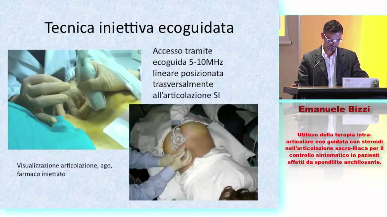 Spondilite anchilosante: utilizzo della terapia intra articolare con steroidi