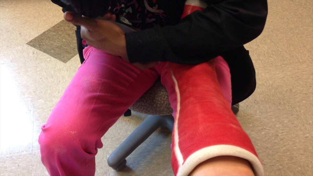 The cast is coming off