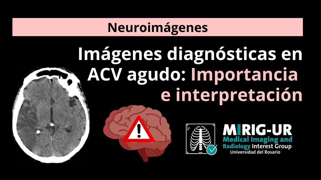 Imágenes Diagnósticas en ACV Agudo: Importancia e interpretación  MIRIG-UR