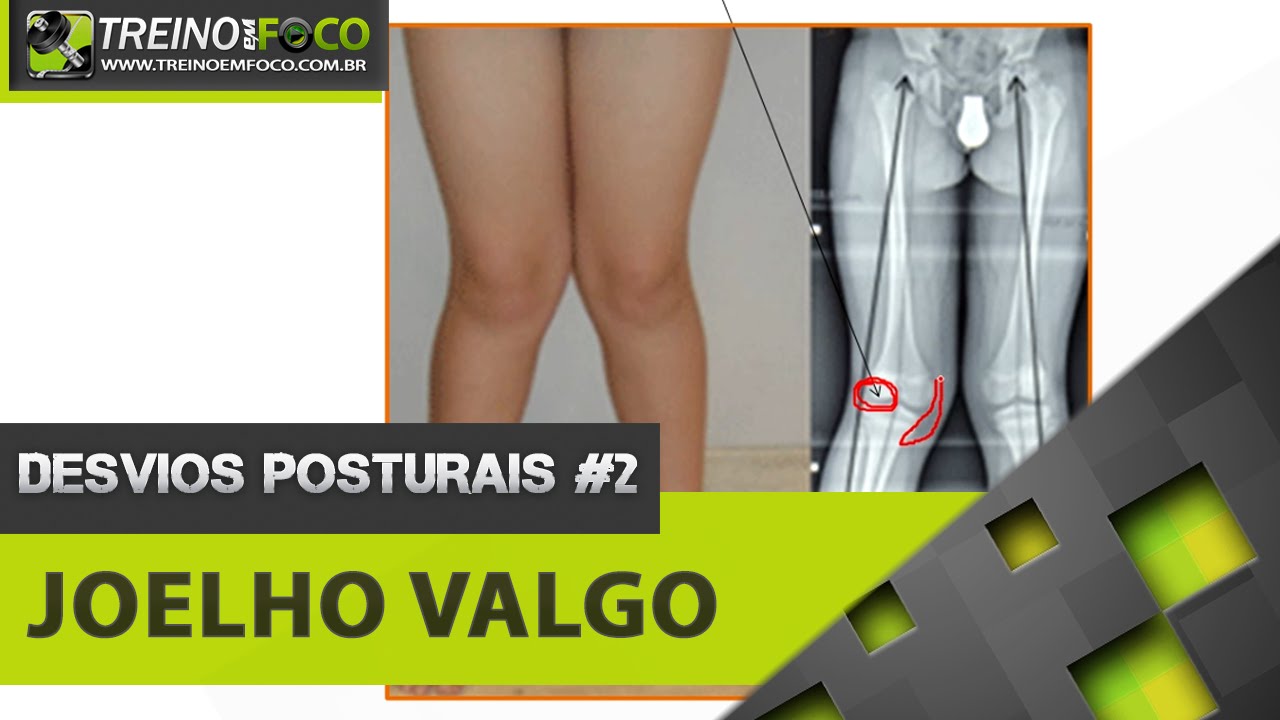 O que é Joelho Valgo? - Desvios Posturais #2