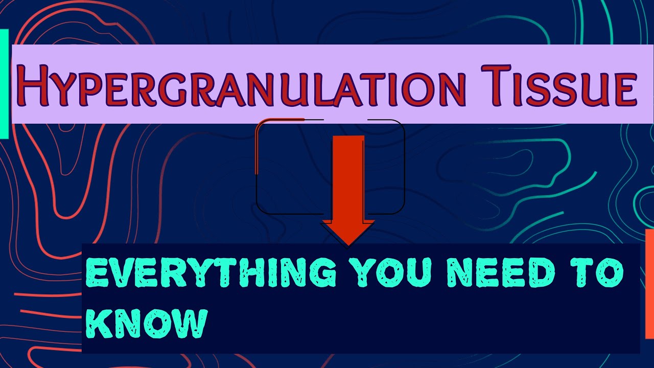 HYPERGRANULATION TISSUE :CAUSES AND MANAGEMENT. Treatment, management of Hypergranulation tissue