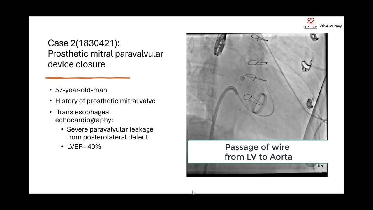 4 challenging cases in a single working day in Cathlab No 8: TAVI, Paravalvular, ASD and SVC