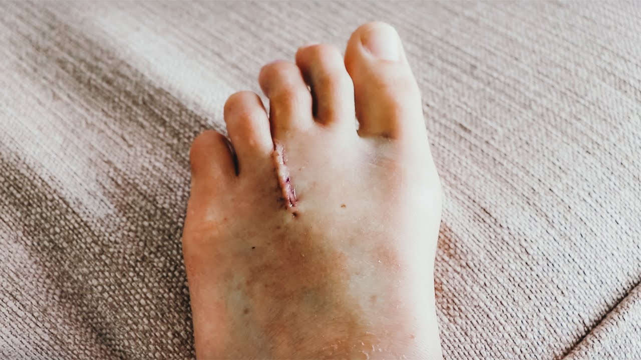 I Had Surgery For Morton's Neuroma - Best Decision!