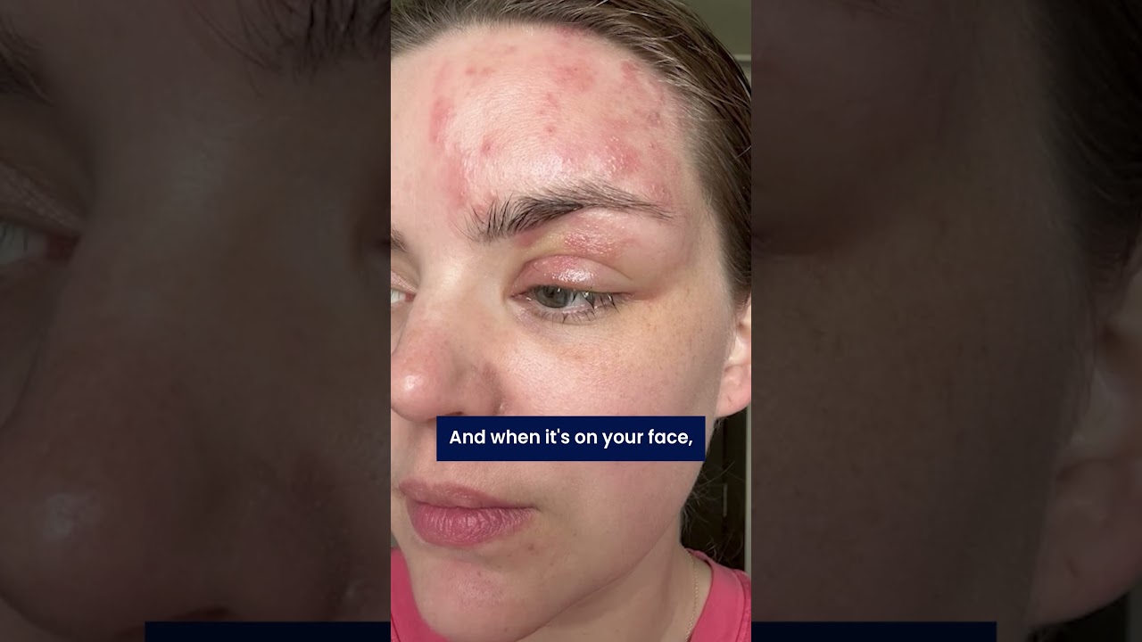 Reporter shares painful shingles journey to warn others at risk