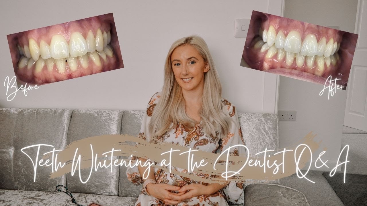 TEETH WHITENING AT THE DENTIST - BOUTIQUE WHITENING REVIEW - FACE DENTAL COVENTRY | Isobel Celine