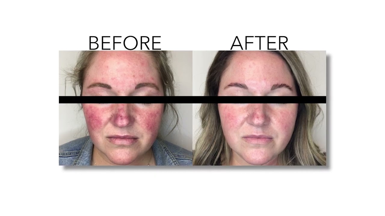 Envision Lumecca Treatment
