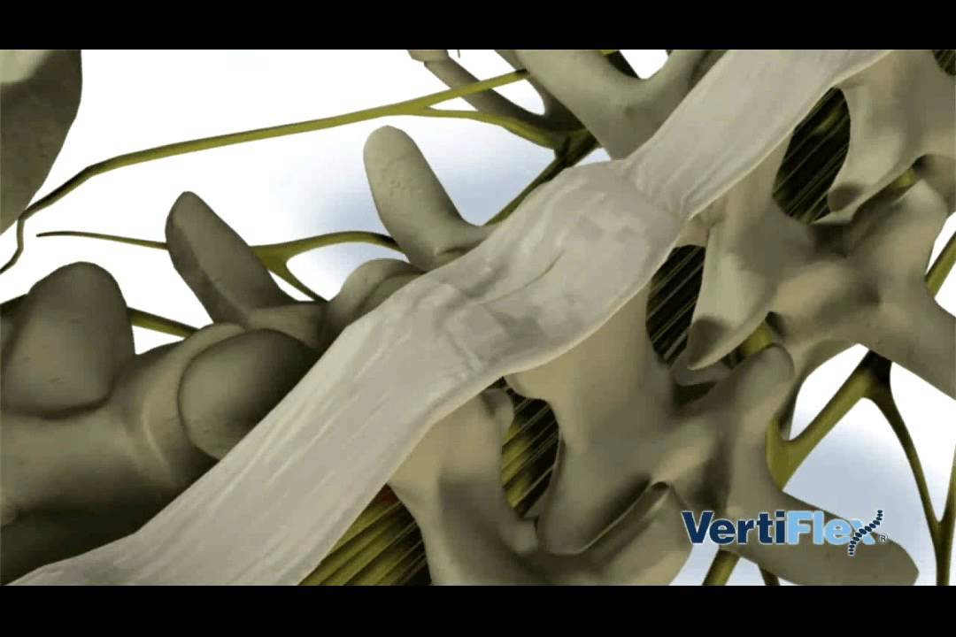 Superion interspinous spacer