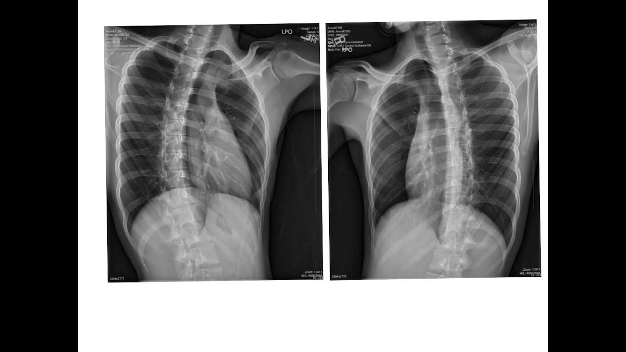ribs