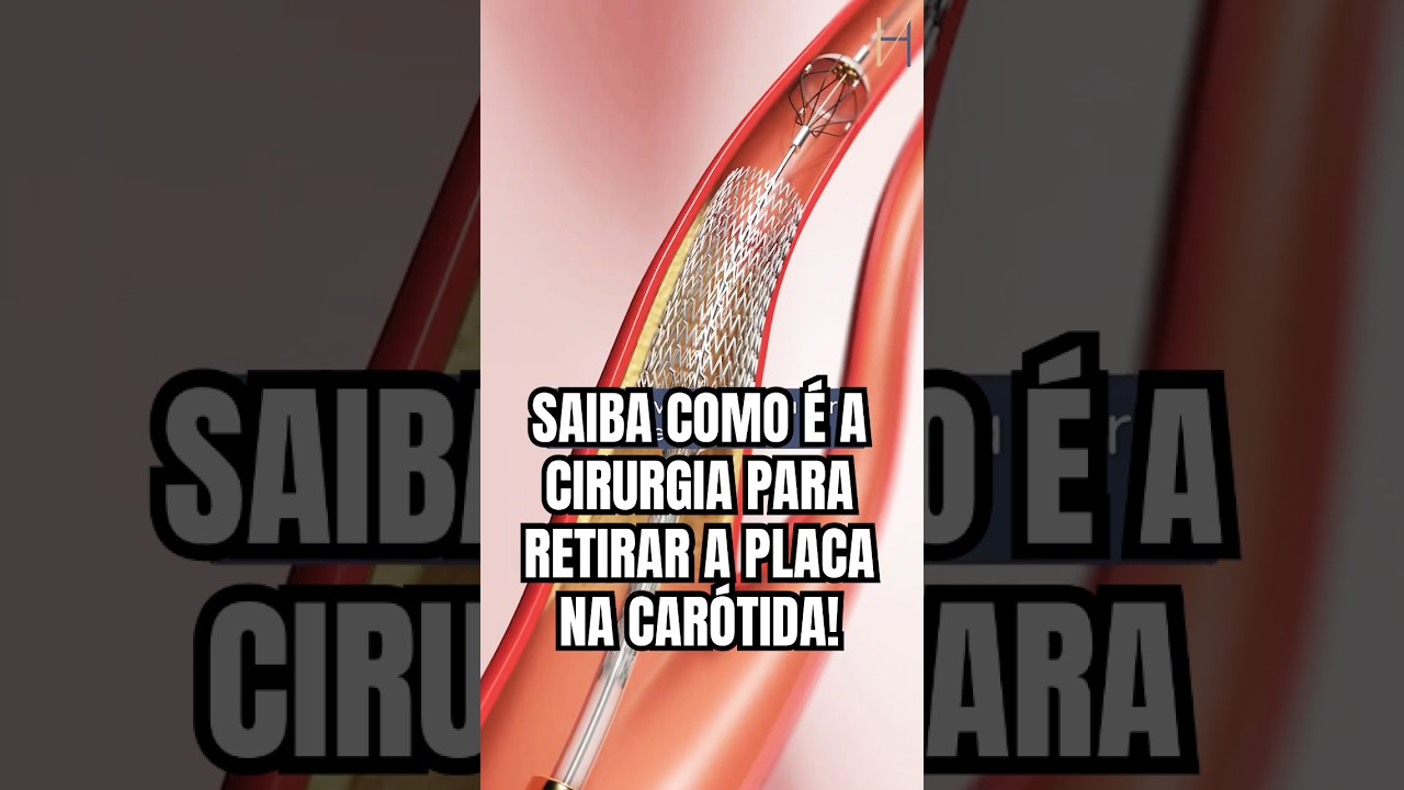 🛠️🧠 CIRURGIA DAS CAR&Oacute;TIDAS: COMO FUNCIONA? | S&Eacute;RIE ESTENOSE DE CAR&Oacute;TIDA Ep. 4