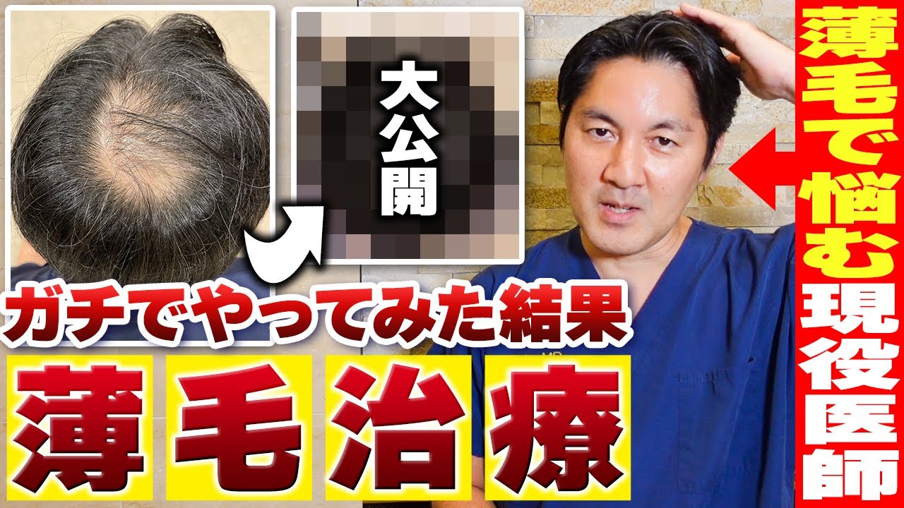 【薄毛で悩む男性必見！】薄毛で悩む現役医師がガチでAGA治療してみた