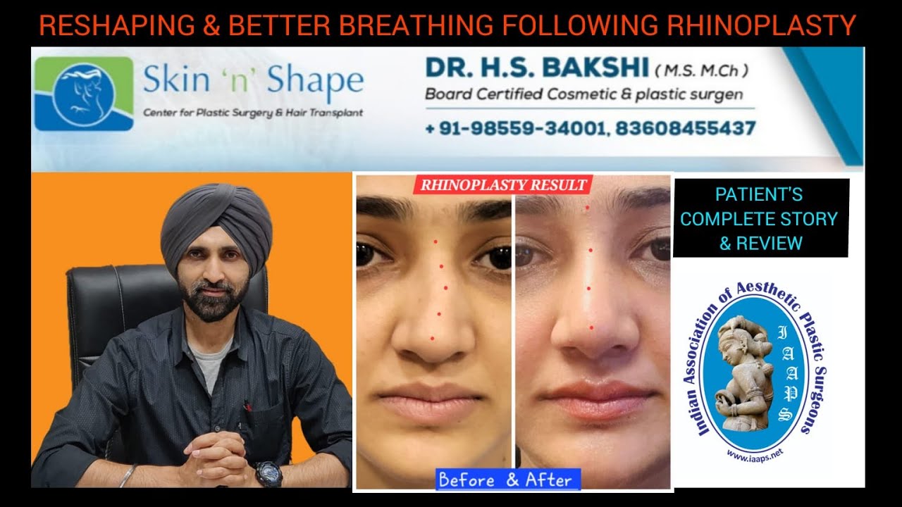 Rhinoplasty Results at Skin-n-Shape Centre, Chandigarh | Dr. Harpreet Singh Bakshi +91-98559-34001