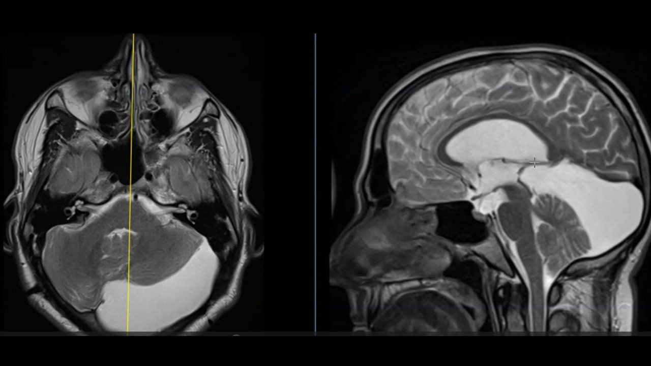 Arachnoid cysts of the brain - 4 examples