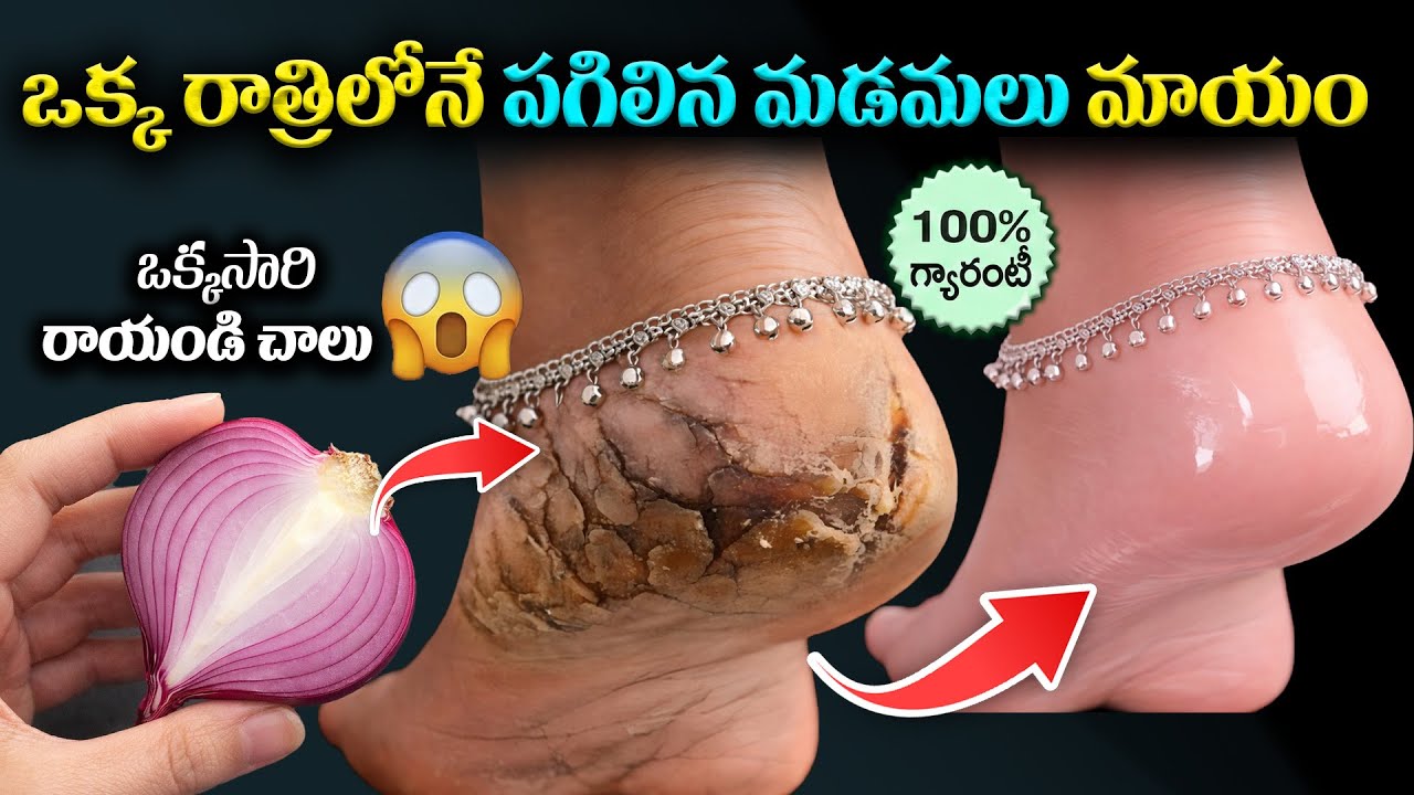100% గ్యారెంటీ! ఒక్క రాత్రిలోనే పగిలిన మడమలు మాయం 😱 | Cracked Heels Home Remedy in Telugu | Ksk Home