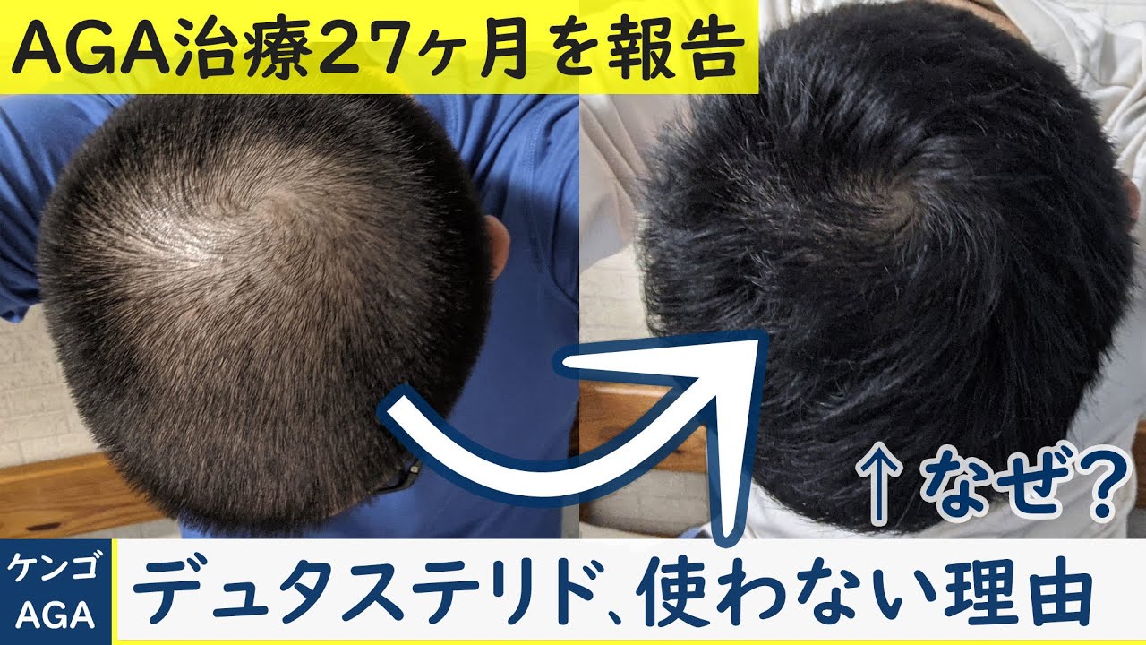 【AGA治療の経過】デュタステリドの効果や副作用をわかりやすく丁寧に解説【フィナステリドと比較】