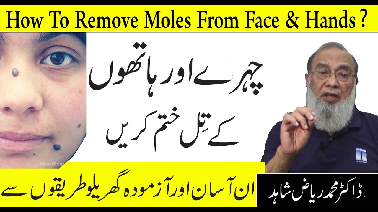 How To Remove Black and Brown Moles Naturally || Chehre Ke Kale Til Khatam Karne Ka asan Tarika