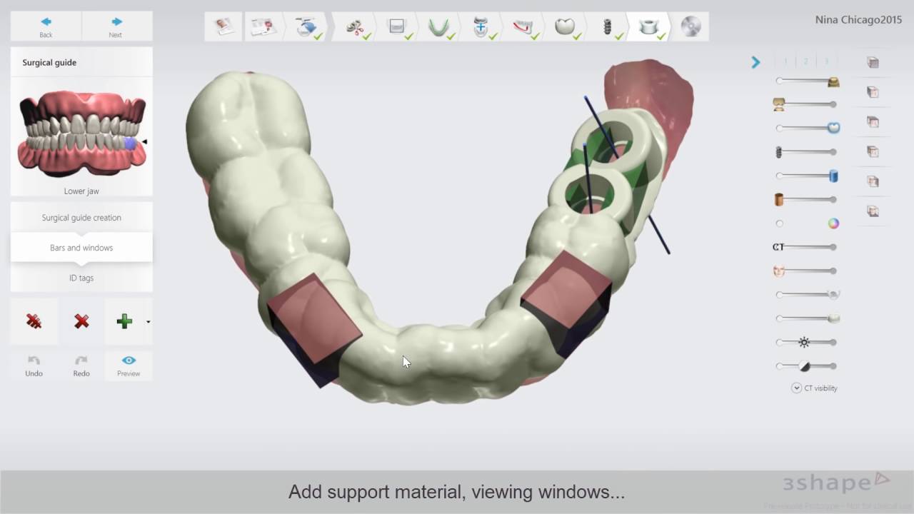 Крестальная имплантация от Implant Studio